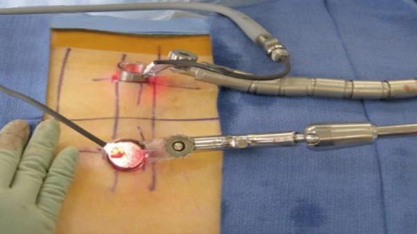 Minimally Invasive Spine Surgery